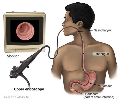 Anesthesia with surgery, endoscopy, colonoscopy Barb Herrera