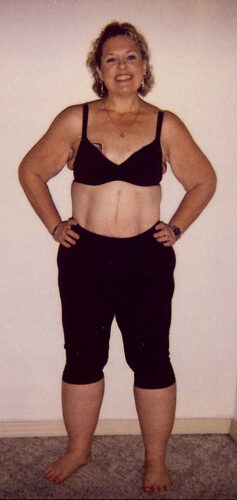 RNY Gastric Bypass 2002 After Barb Herrera