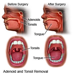 Kids on GLP-1 Tonsillectomy Childhood Obesity Barb Herrera