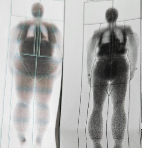 DEXA/DXA Scan Barb Herrera