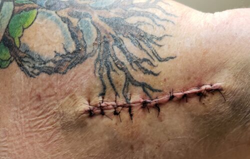 Skin Cancer Surgery Scar Barb Herrera