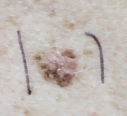 Malignant Melanoma Stage 2 Barb Herrera